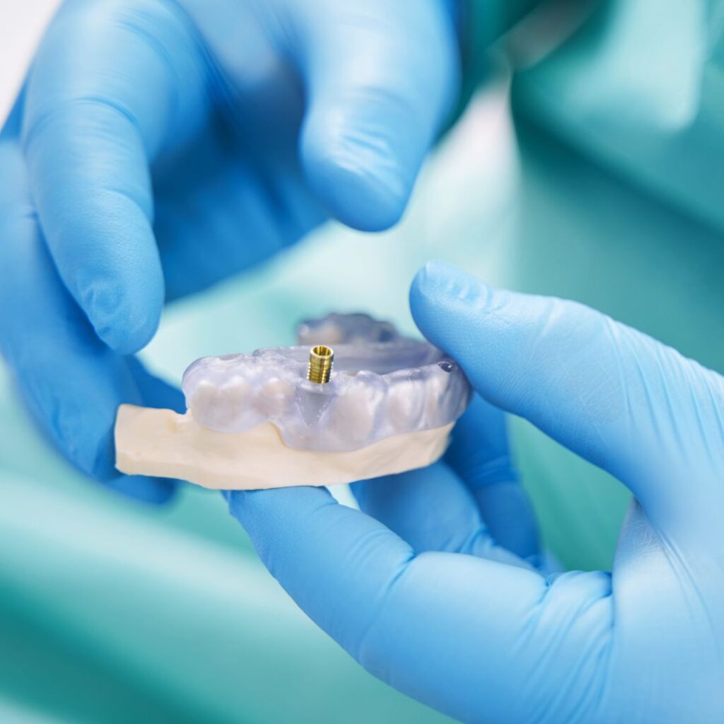 partes de un implante dental